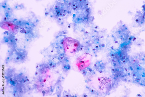 View in microscopic of human skin cells.Squamous epithelium cells.Bacterial vaginosis in pap smear.Cytology and pathology laboratory department.Magnification 400 X