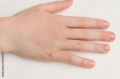 Child touches his hand with common viral flat warts Verruca vulgaris, scratches them, close-up. Human papillomavirus, HPV. Pediatric dermatology concept.