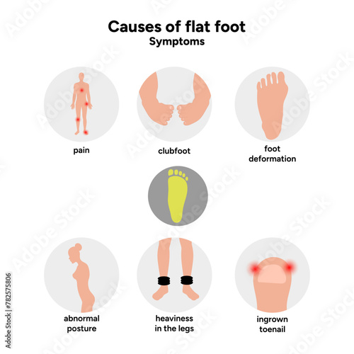 Causes of flat foot