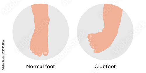 Clubfoot and normal foot