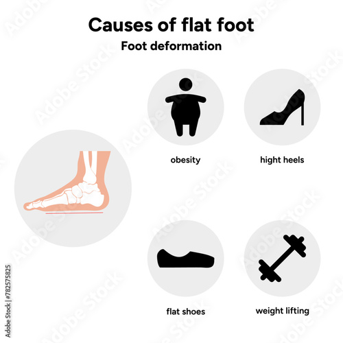 Causes of flat foot