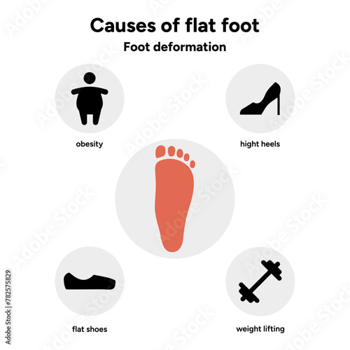 Causes of flat foot