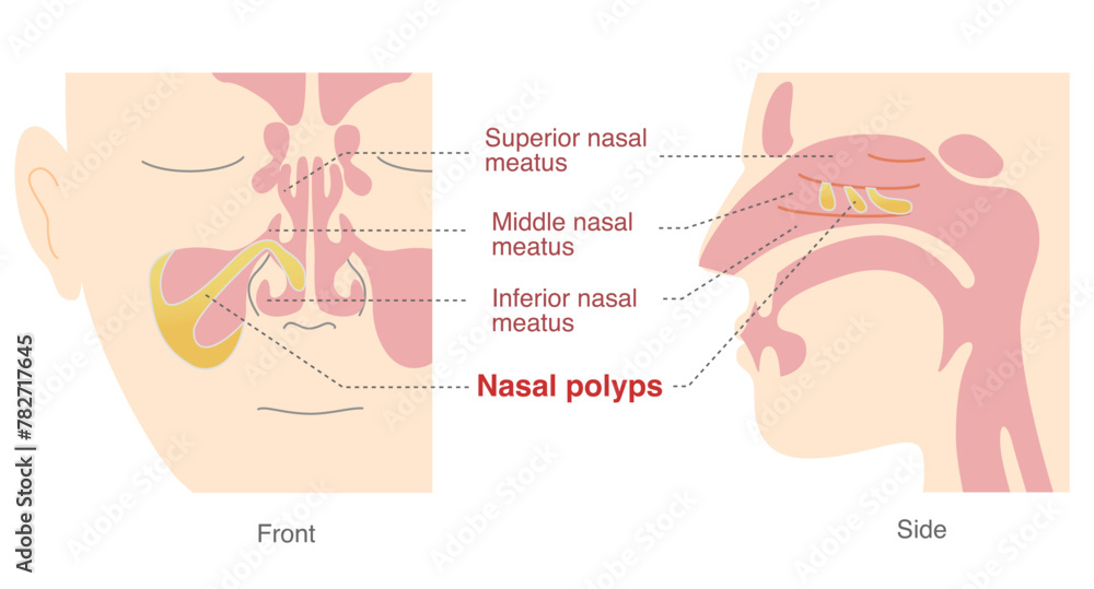 Obraz premium Illustration of nasal polyps in the sinuses from front and side views