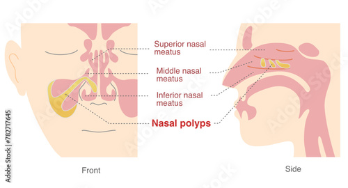 Illustration of nasal polyps in the sinuses from front and side views photo