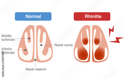 Dilatation of blood vessels in the Inferior meatus during rhinitis and stuffy nose