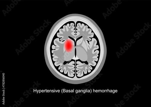 Basal ganglia hemorrhage brain scan illustration.