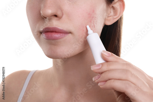 Young woman with acne problem applying cosmetic product onto her skin on white background  closeup