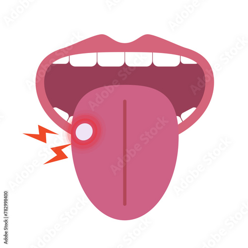 Mouth with canker sore. Vector.