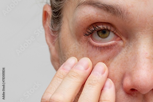 Cropped woman face with fingers under eye showing redness in eye photo