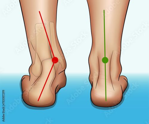 Vector illustration in realistic style depicting the medical problem of foot or ankle curvature or deformity, valgus deformity and flat feet problem. photo
