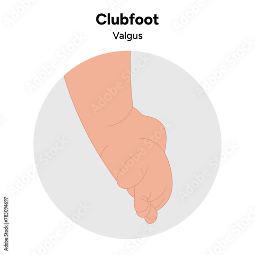 Valgus Clubfoot problem foot. Orthopedic infographic diagram