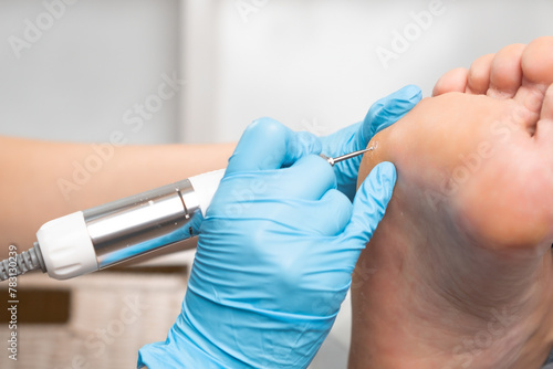 A podologist using electric drill removes a callus from a womans foot at the medical center