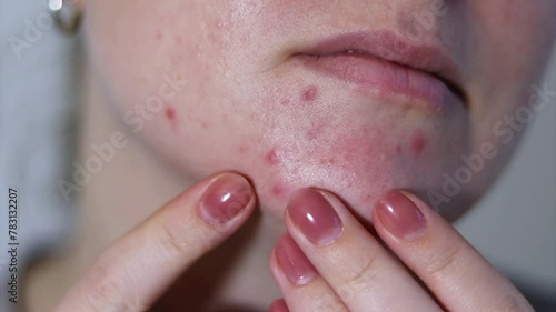 Close up of female face with red problematic acne skin