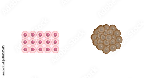 Healthy tissue and Malignant (cancerous) tissue. Cancer disease development. Malignant tumor. Medical biological, scientific vector illustration.