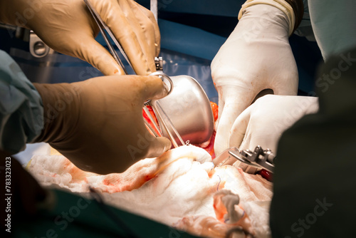 A group of surgeons remove a surgical operation to cut out a cancerous tumor or liver, kidney, cardiac surgery and organ transplant. Colorectal surgery to remove abdominal cancer. photo