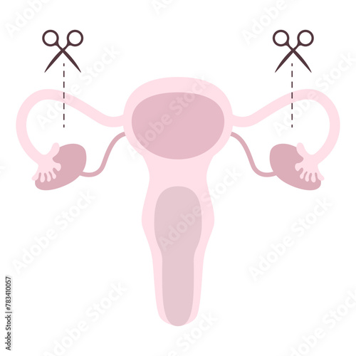Tubectomy Reversal. Tubal ligation or surgical procedure tubectomy in operative gynecology concept. Tubal ligation and tubectomy - reproductive female and woman organ after sterilization