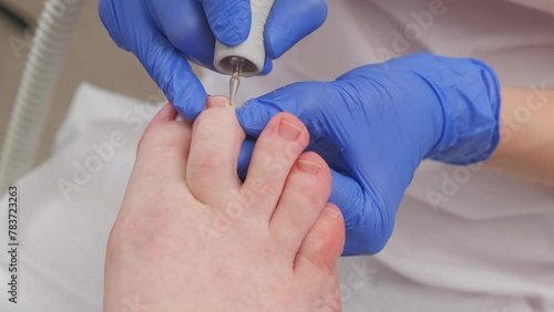 A professional podologist will separate the ingrown toenail on the second toe from the skin of the female client with a special tool. Foot care photo