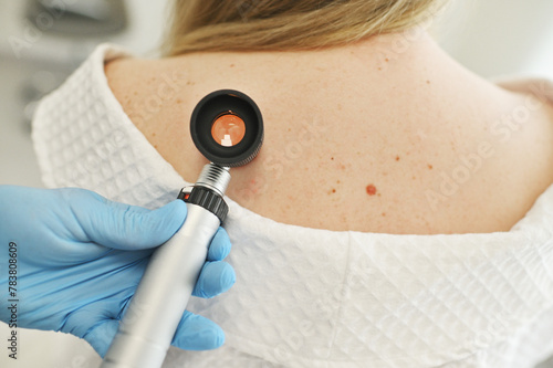a dermatologist examines moles and skin growths on the patient's body using a special device - a dermatoscope. Diagnosis and prevention of melanoma. © Evgeniy Kalinovskiy