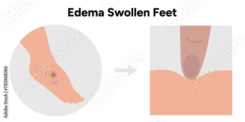Edema swollen foot 