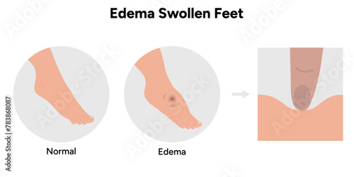 Edema swollen foot 