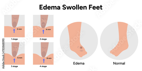Edema swollen foot 