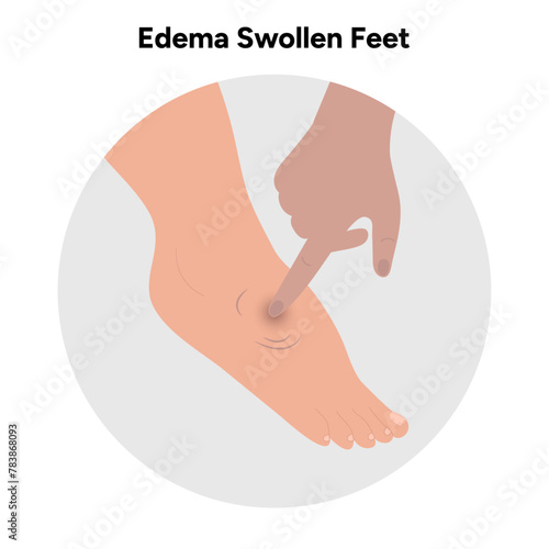 Edema swollen foot 