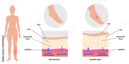 Edema foot, medical infographic 