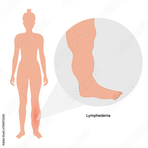 Edema swollen feet. Lymphedema foot. Orthopedist diagram 