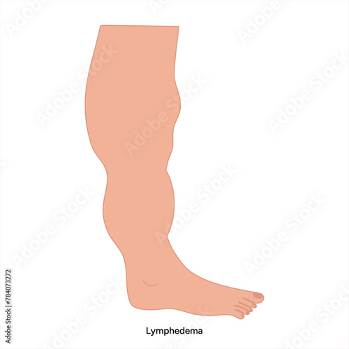 Edema swollen feet. Lymphedema foot. Orthopedist diagram 