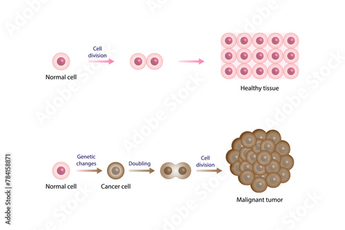 Healthy tissue and Malignant (cancerous) tissue. Cancer disease development. Malignant tumor. Medical biological, scientific vector illustration.