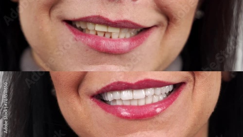 Close-up of woman's smile before and after zirconia veneers, dental ceramic crowns. Female patient smiling before and after cosmetic dental treatment by veneers. Smile makeover with ceramic veneers.