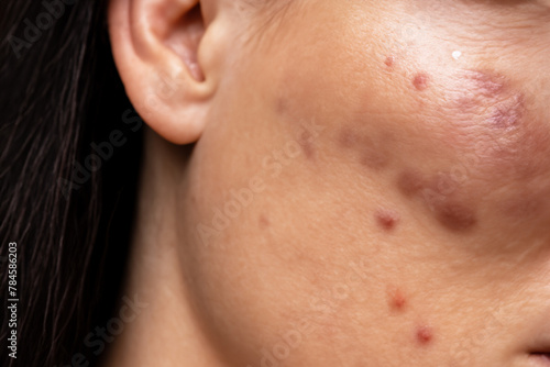 Spots on the skin. Close up of a man with acne on his face, studio shot. Young woman with acne problem on her face. Skin care concept. Acne on the face of a young man.