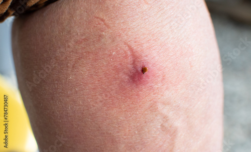 An infected female deer tick on a human leg. A tick bites a person, redness of the skin. Parasitic tick. A dangerous biting insect on the background of a detail of the epidermis.
