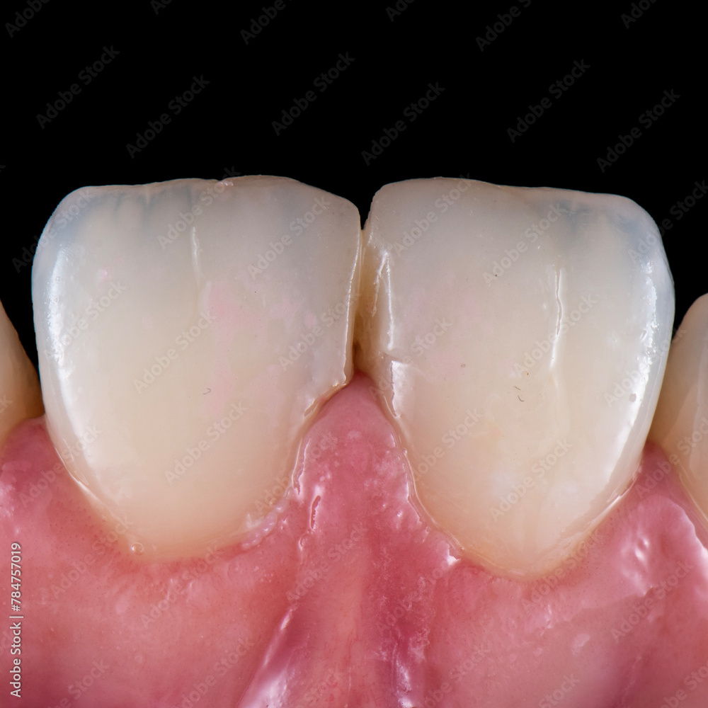 Fototapeta premium emax ceramic veneers