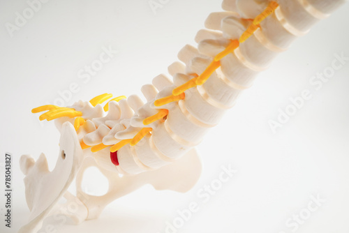 Spinal nerve and bone, Lumbar spine displaced herniated disc fragment, Model for treatment medical in the orthopedic department..