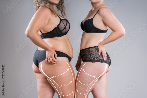 Two overweight fat women with cellulitis, obesity hips and buttocks on gray background, obese female body, liposuction and plastic surgery concept with surgical lines and arrows