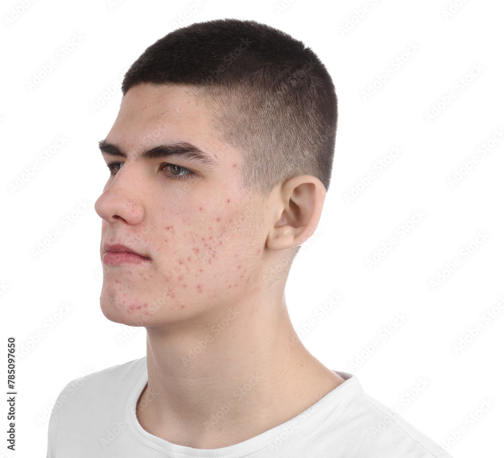 Fototapeta premium Young man with acne problem isolated on white