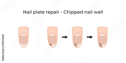 Nail plate repair - Chipped nail wall