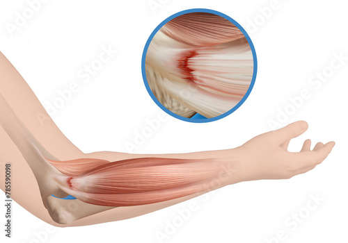 Tennis elbow_Lateral epicondylitis_Medical illustration_Elbow anatomy illustration