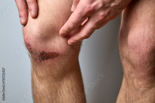 scratch, knee wound on a man's knee
