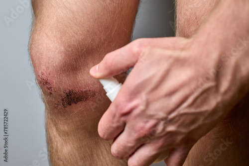 the wound on the knee was treated with hydrogen peroxide