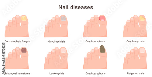 Nail diseases, nail fungal infection. Onychomycosis, onycholysis. Problem toenail Vector illustration of nails