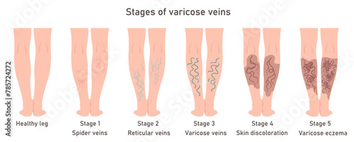 Stages of varicose veins. Varicose veins in women. Image of healthy and diseased legs. Varicose infographic photo