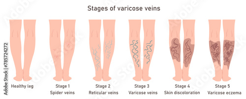 Stages of varicose veins. Varicose veins in women. Image of healthy and diseased legs. Varicose infographic