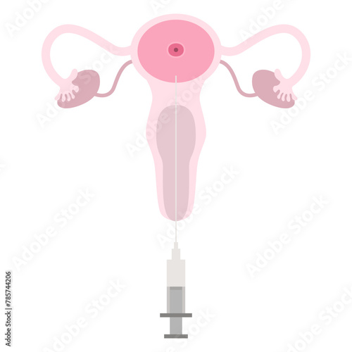 Artificial insemination. In vitro fertilization IVF Artificial insemination and pregnancy ICSI technology. ET Embryo Transfer vector illustration. Reproduction, insemination or ivf