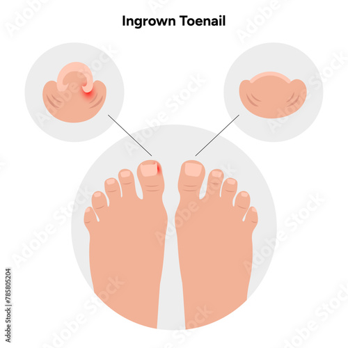 Ingrown toenail threads , podiatrist 