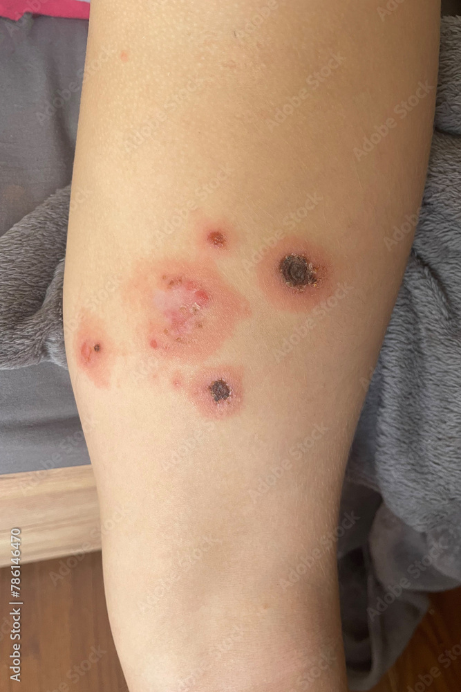 Body with skin problem. Streptoderma on human skin close up. Strep