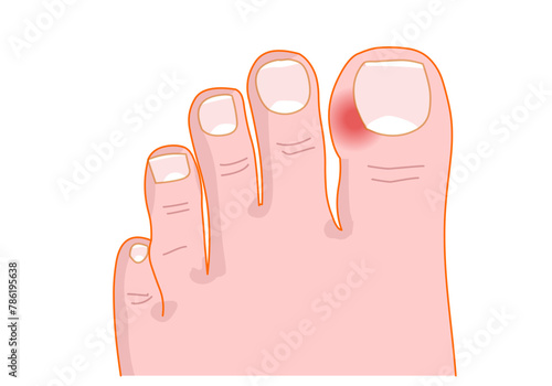 Paronychia is an infection of the proximal and lateral toenail and fingernail fold. Nail fold infections. Vector illustration photo