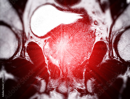 MRI of the prostate gland reveals a focal abnormal signal intensity (SI) lesion at the left posterolateral peripheral zones at the apex, aiding in diagnosing tumors and guiding treatment decisions. photo