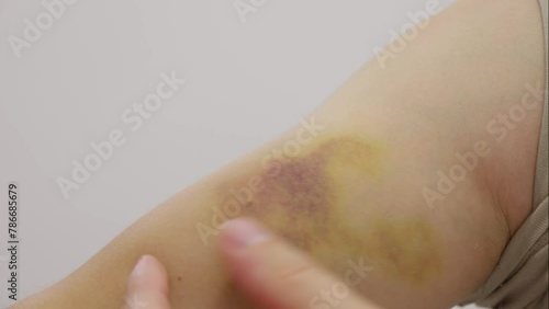 Man showing his bruise on forearm. real huge colored hematoma on hand close up  photo